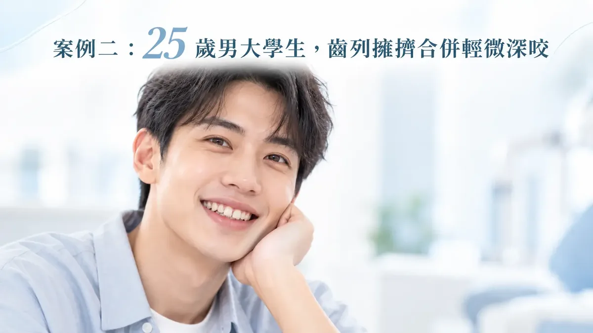 隱適美矯正齒列擁擠與輕微深咬：25 歲男大生案例示意