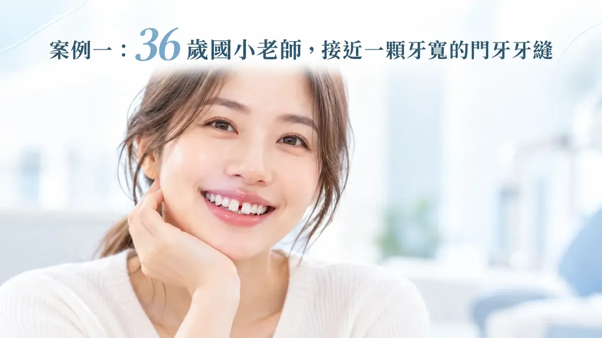 隱適美關閉前牙牙縫：高雄國小老師矯正案例示意
